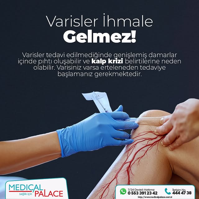 Gelişen Teknolojiyle Ameliyatsız Varis Tedavisi Mümkün Oldu